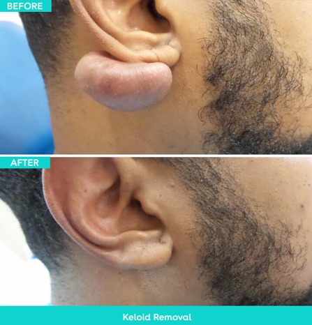 keloid removal MIami