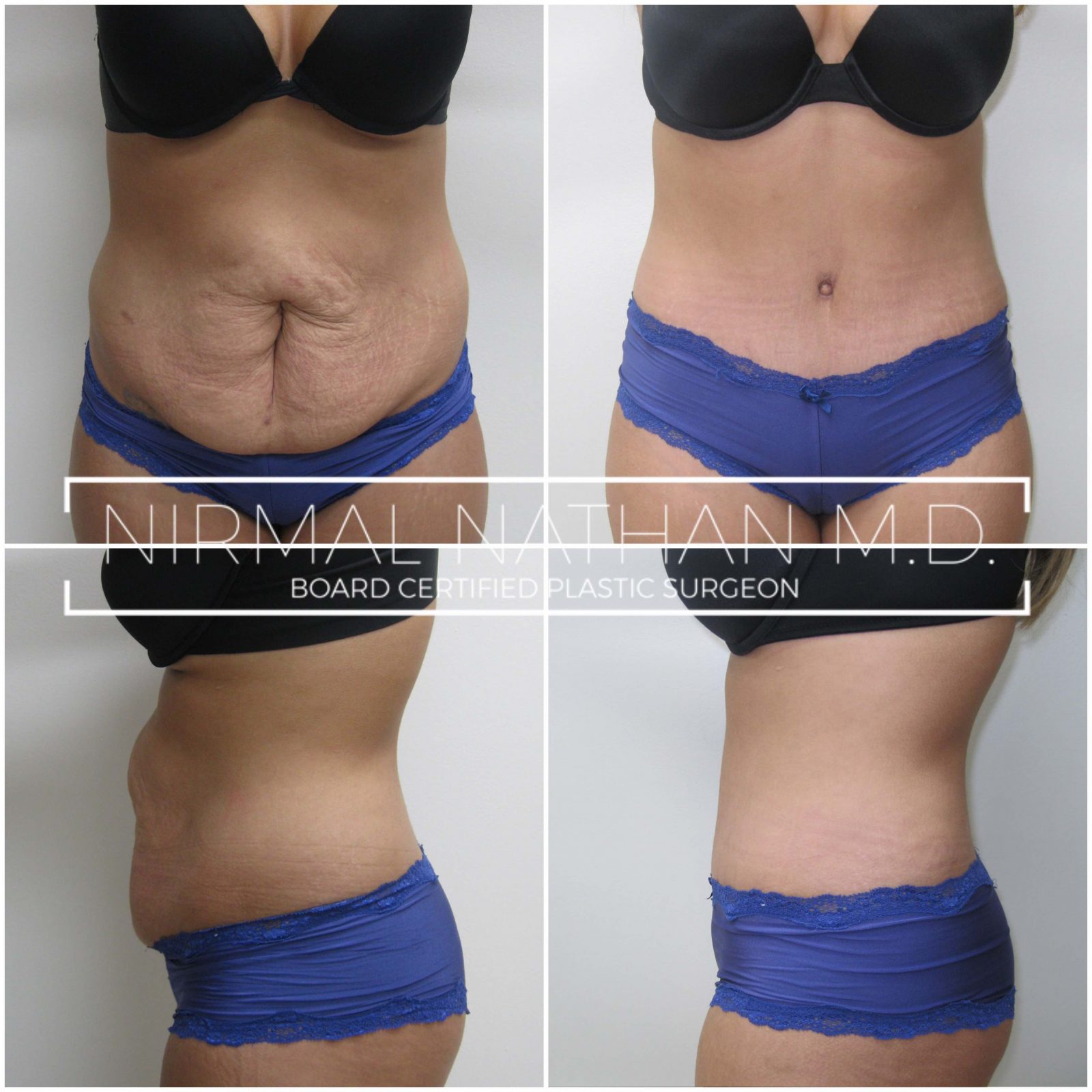 Tummy Tuck Before and after
