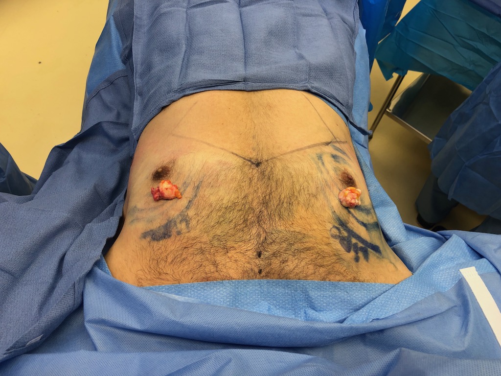 gynecomastia Dr. Karan Chopra