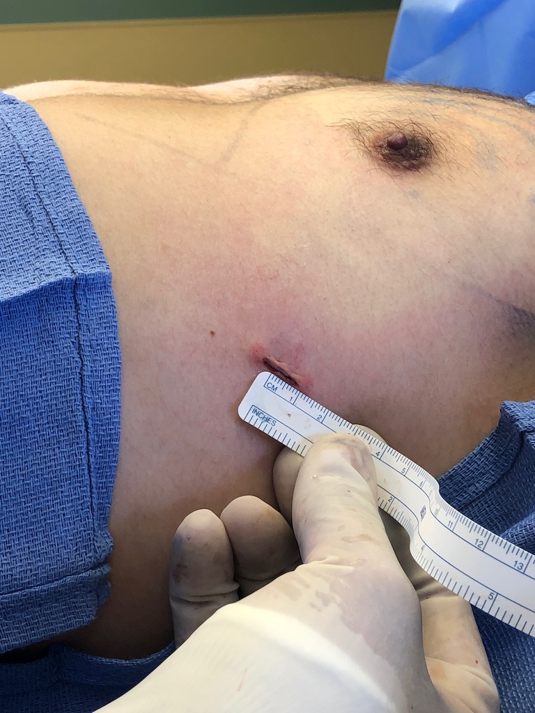 gynecomastia