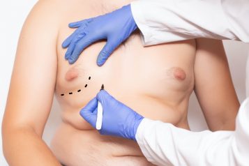 Correcting Gynecomastia Or “Man Boobs”