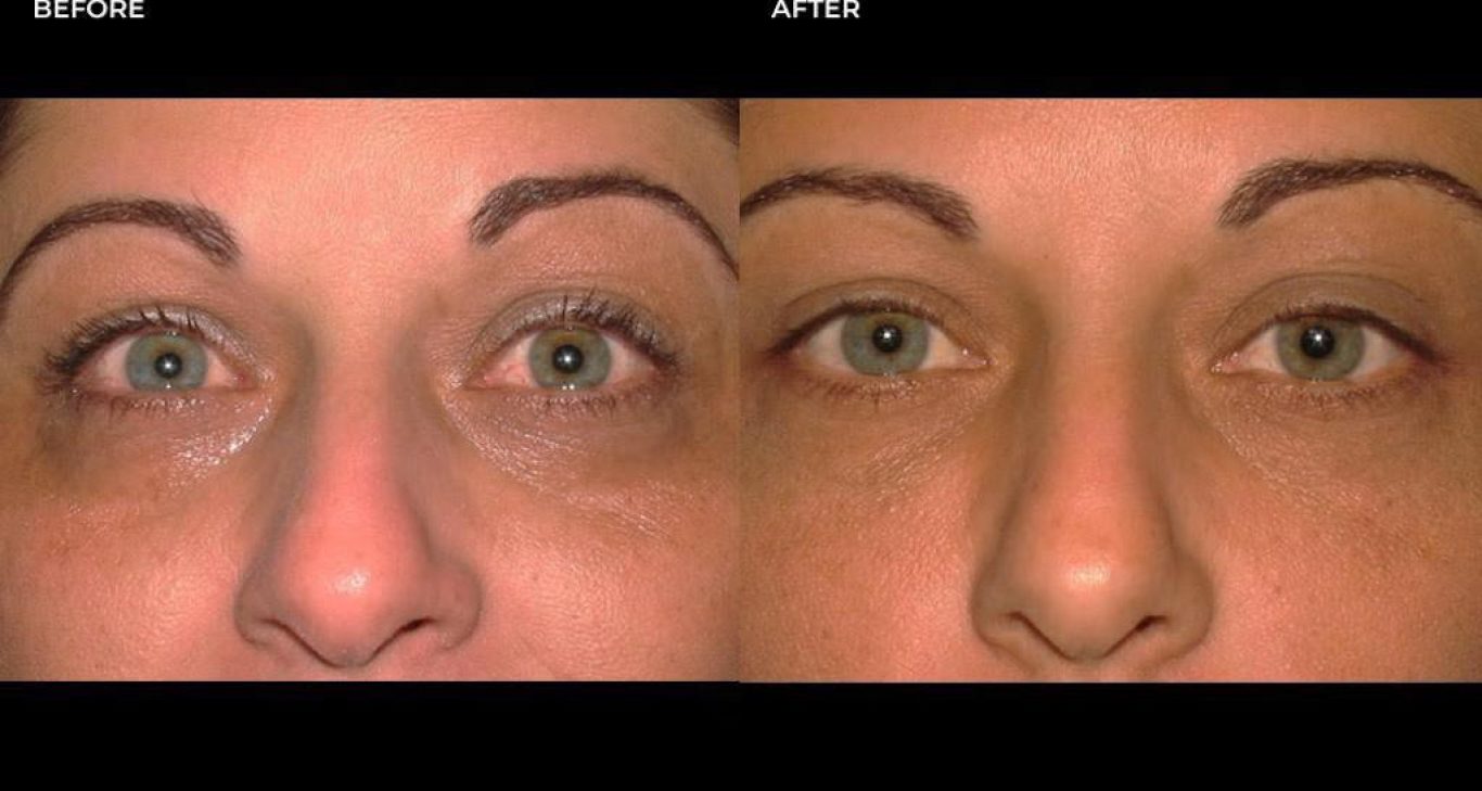 Treatment for undereye dark circles, Plastic Surgeon San Francisco