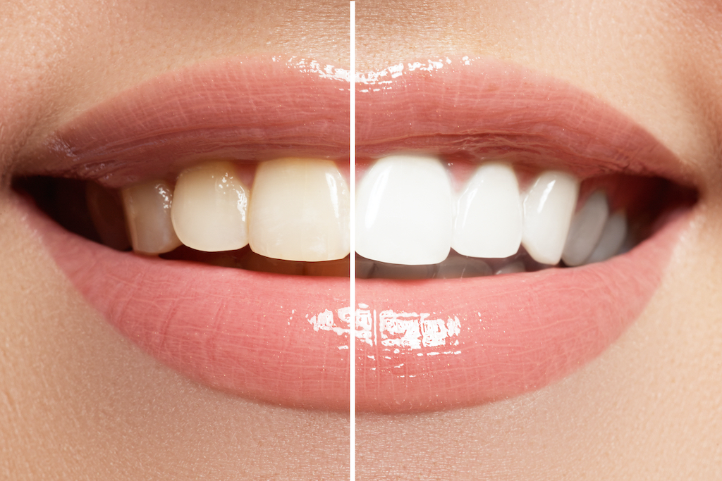 All Your Options When It Comes To Teeth Whitening