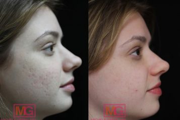 acne scar treatment nyc