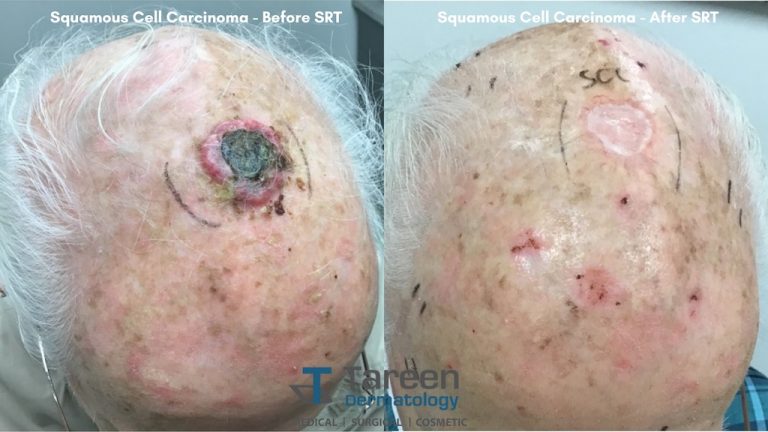 Tareen Dermatology: Superficial Radiotherapy Skin Cancer Treatment