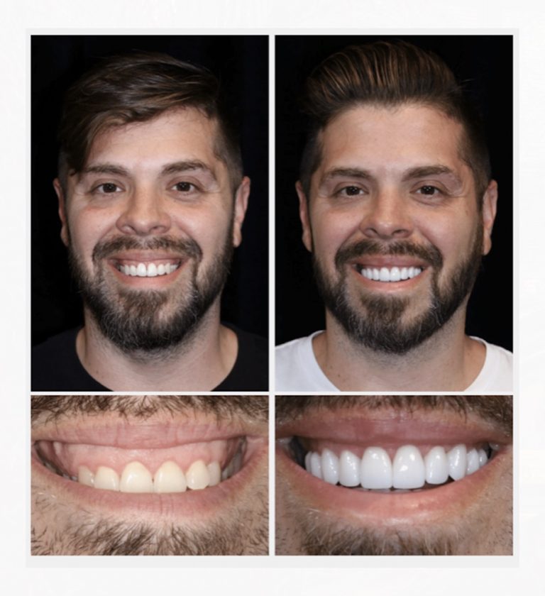 Is A “Gummy Smile” Making You Self-Conscious?