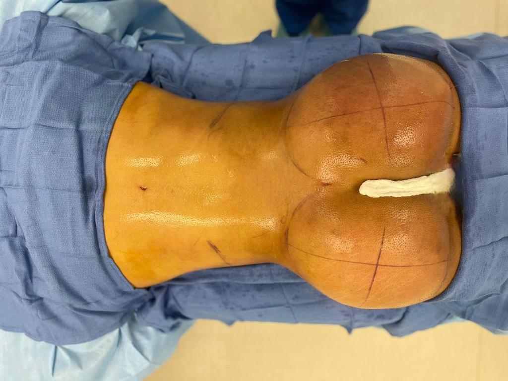 Brazilian Butt Lift in Miami - Salas Plastic Surgery