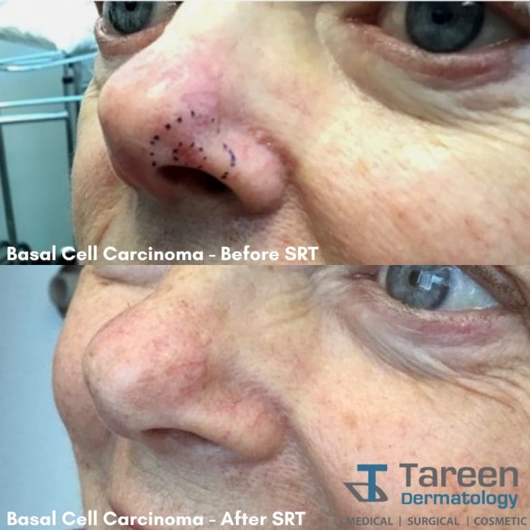 Tareen Dermatology Superficial Radiotherapy Skin Cancer Treatment