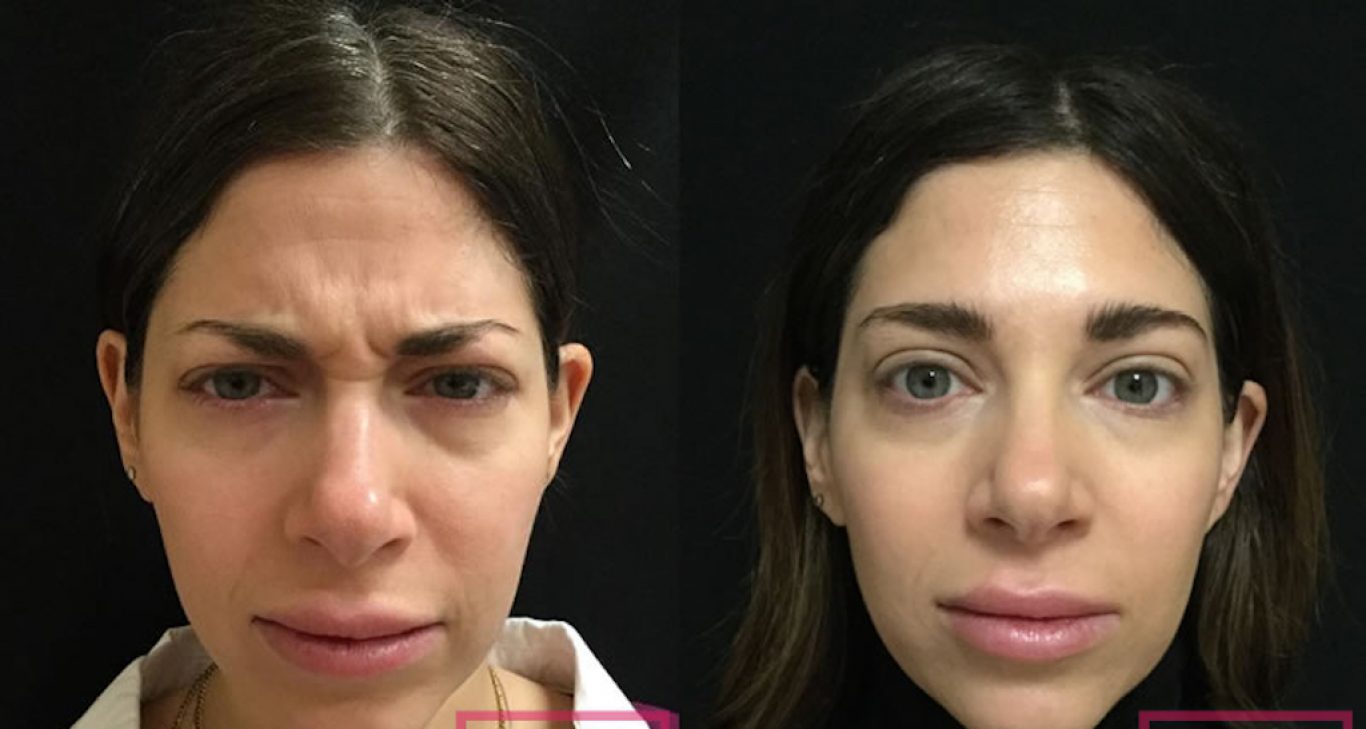 Learn how long Botox lasts & when to touch up - BabyFace MedSpa AZ