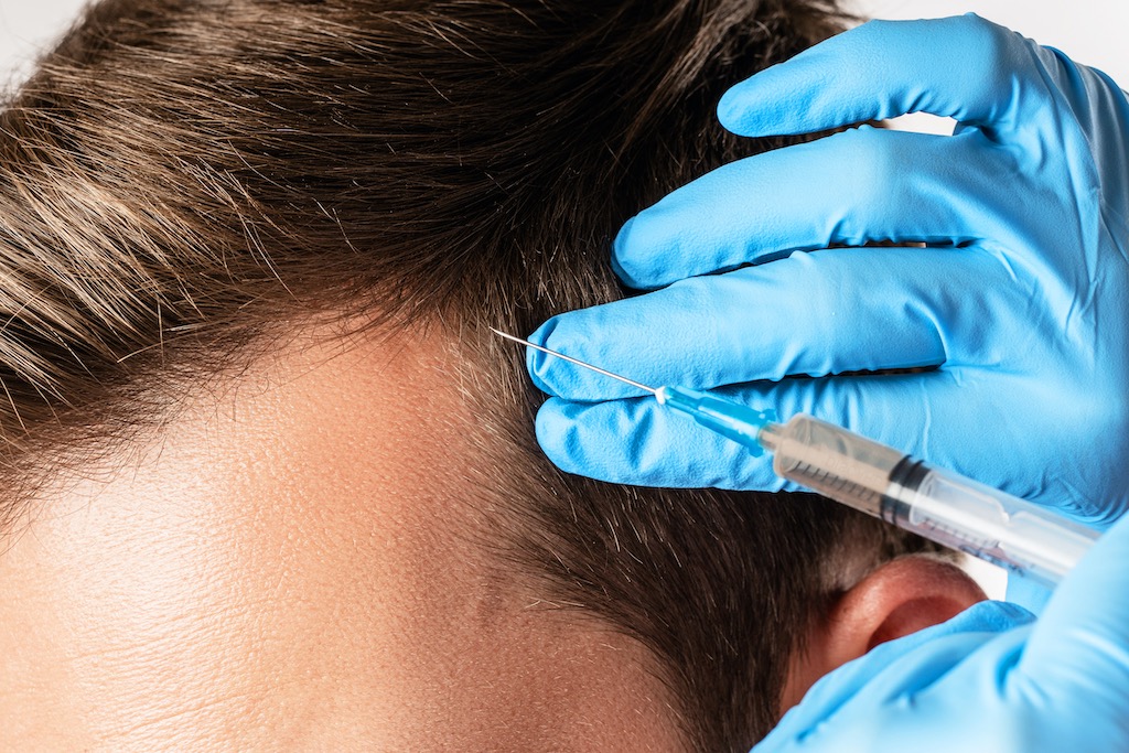How Dr. Rawal Uses PRP To Effectively Treat Hair Loss