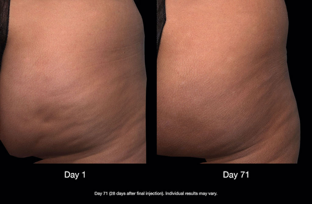 Cellulite? Here Are The Best Cellulite Reduction Treatments