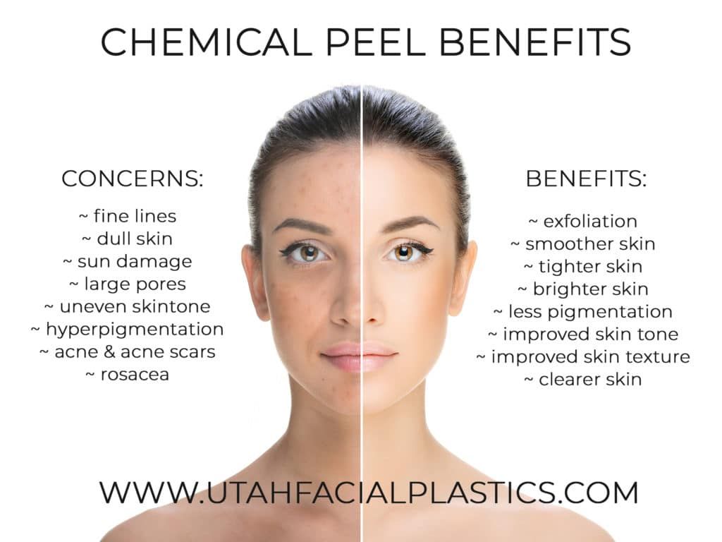 chemical peel