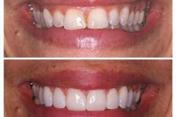 Multistep Smile Makeover: Invisalign, Teeth Whitening, Gum Lift, Veneers