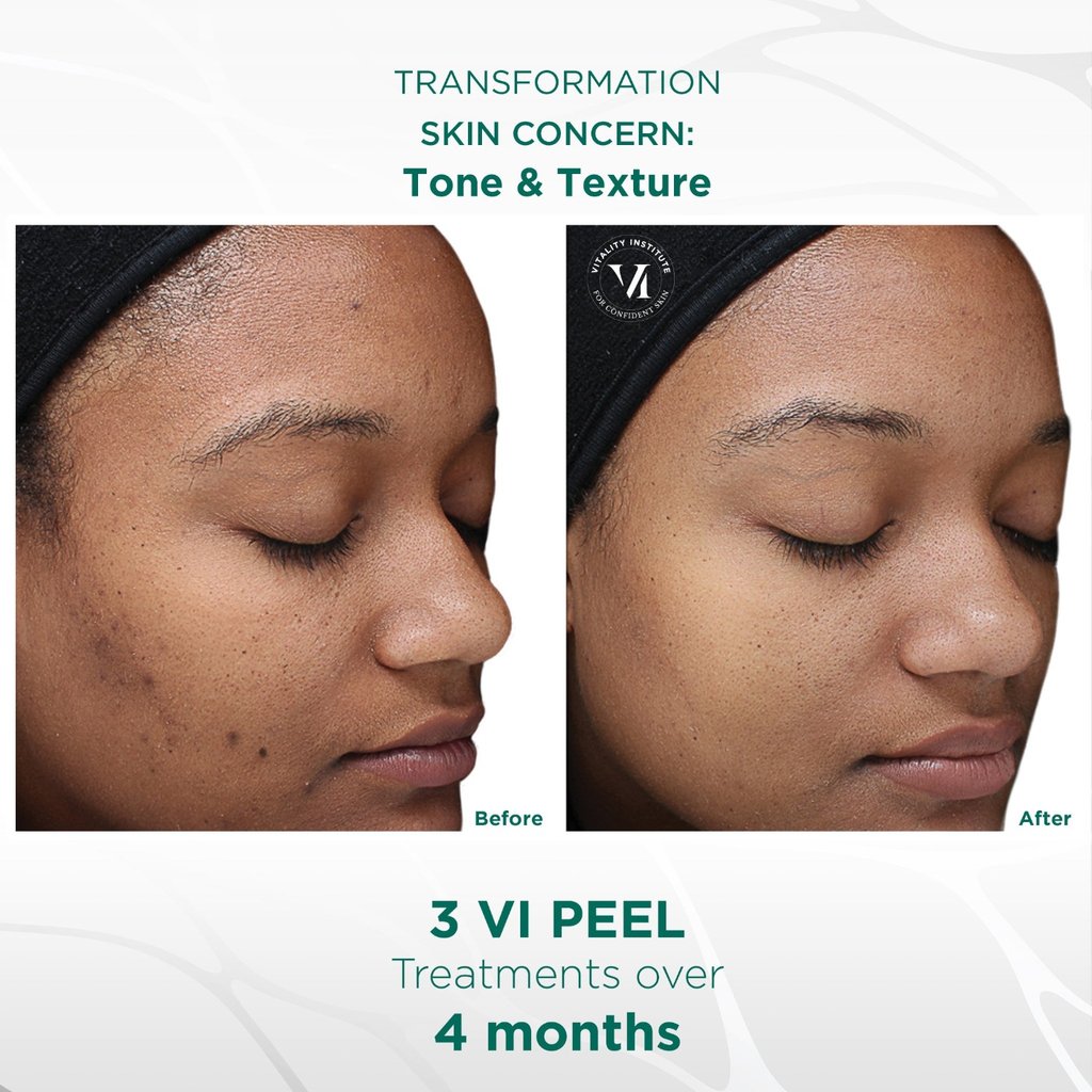 chemical peel