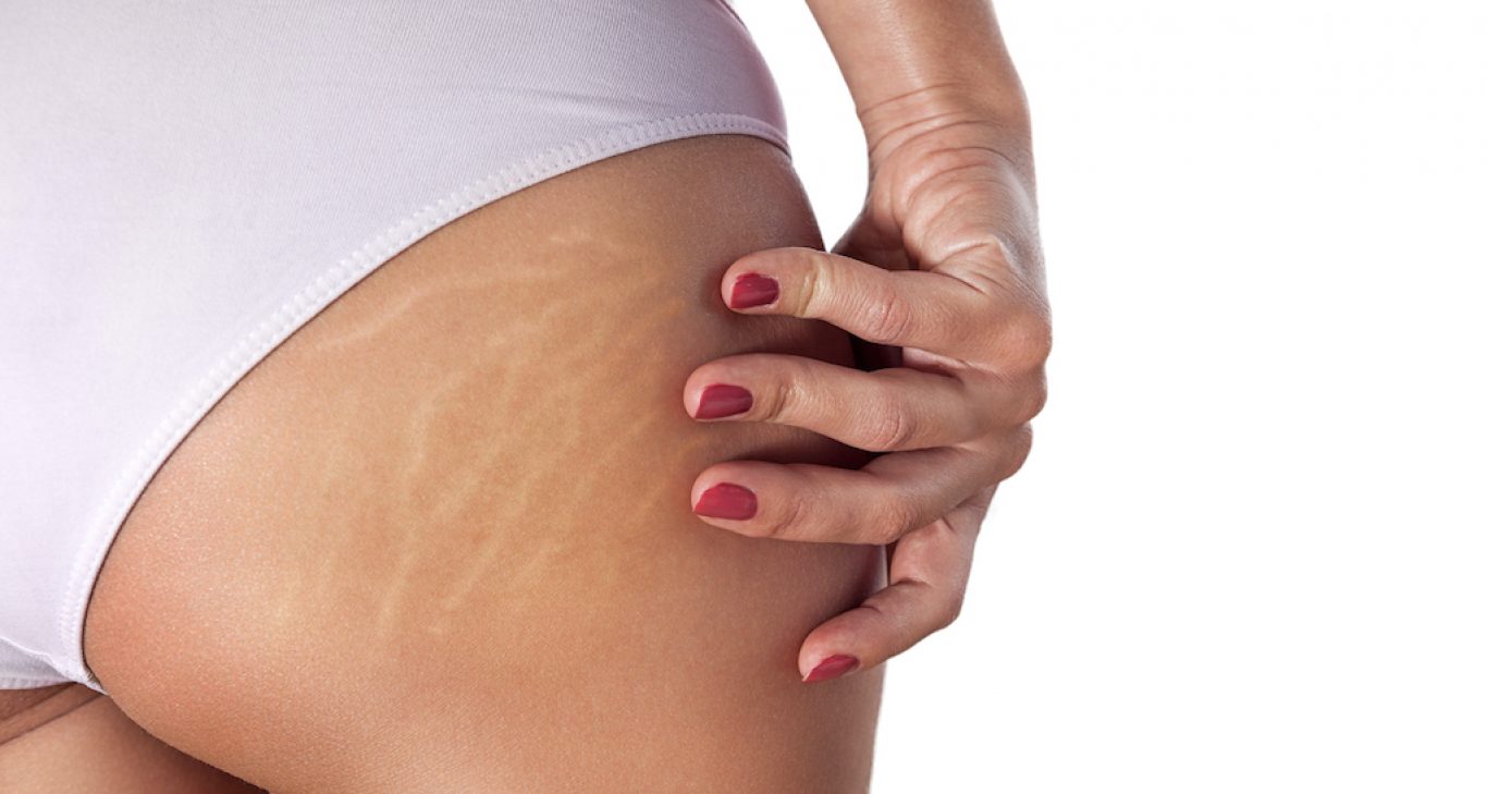 Stretch Marks? The Science Behind The Cause And How To Treat Them