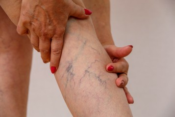 Your Minimally-Invasive Options For Spider Vein Treatment