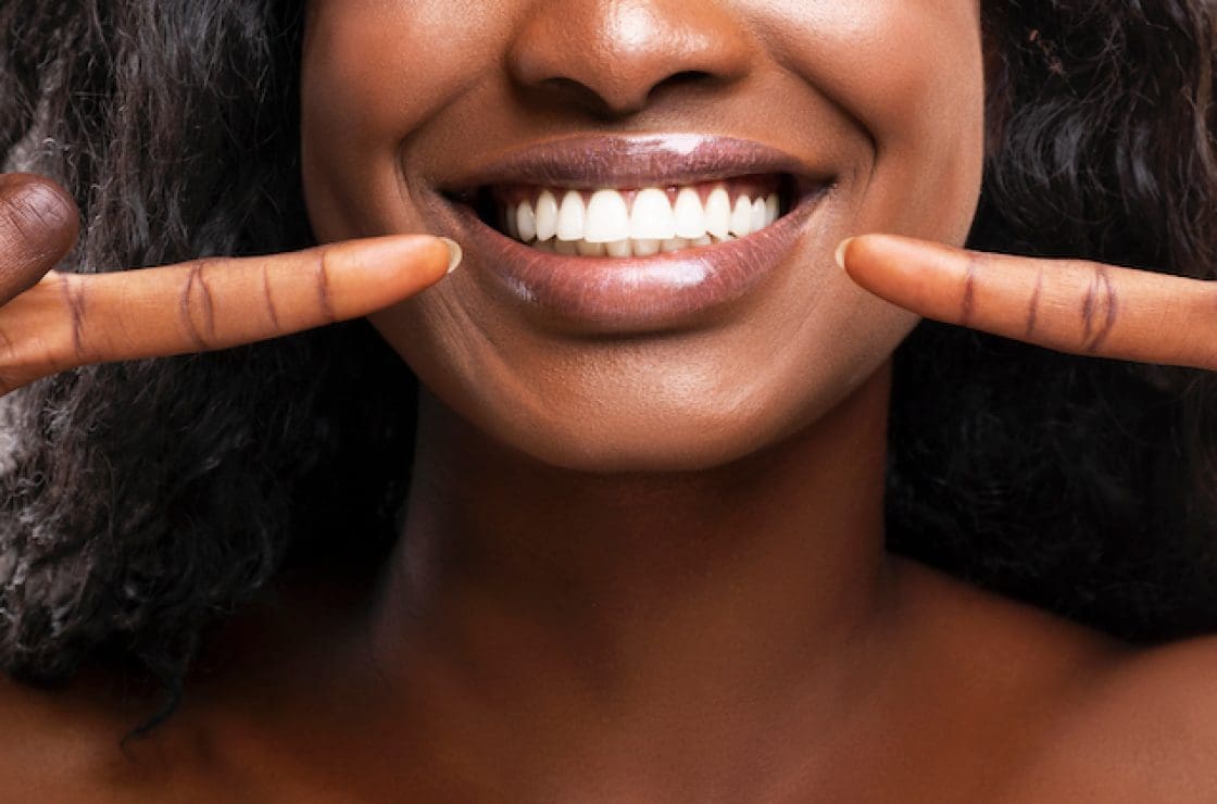 teeth whitening