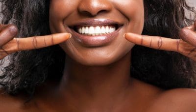 teeth whitening