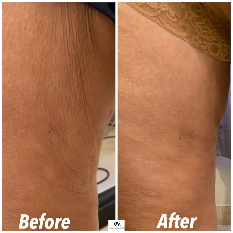 Heres How Full Body Skin Tightening Is Possible With Sculptra