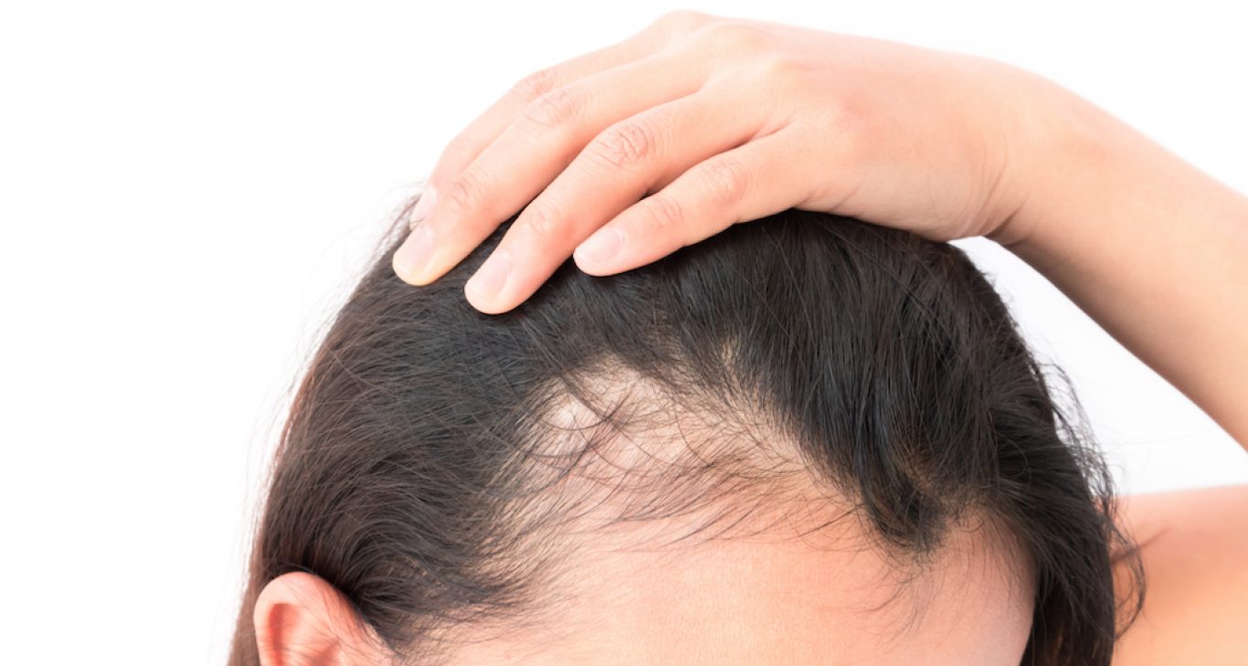 Pulling Your Hair Back Too Tight Causing Hair Loss? Traction Alopecia  Treatment Options
