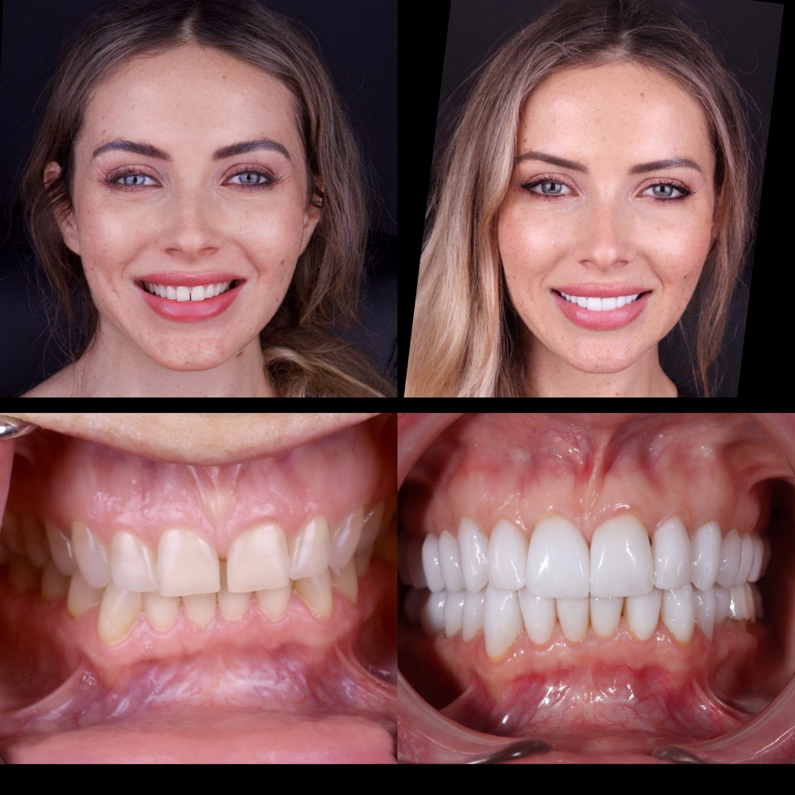 Tetri’s Smile Dentistry can bring back your youthful smile with bite correction services. 
