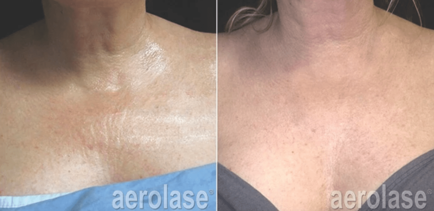 Your Aging Skin Won t Be Able To Compete With This Laser Treatment