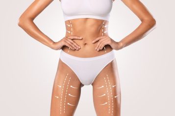 Emsculpt NEO: A Body Sculpting Treatment