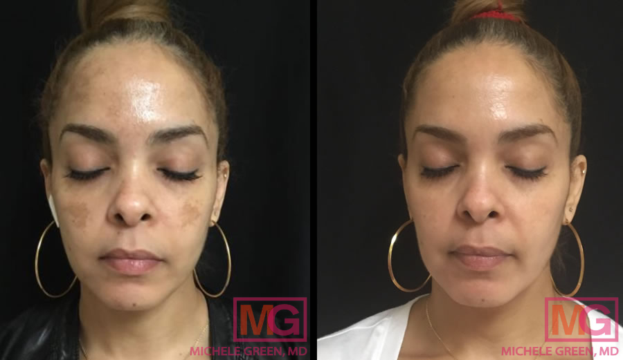 Dermamelan Intimate, Skin Lightening for Intimate areas - Dr. Michele Green  M.D. NYC