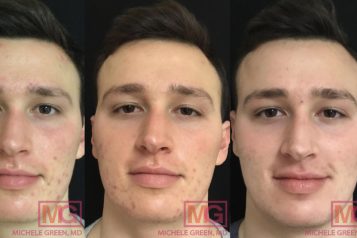 MG-19-before-after-accutane-acne-1-to-5months-MGWatermark