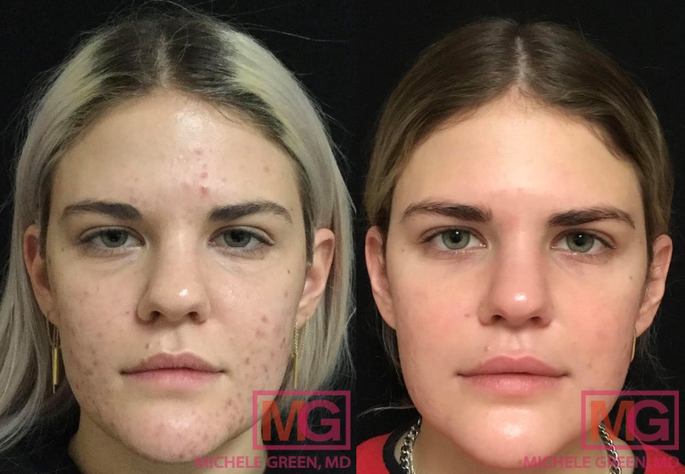 Chemical Peels Before & After Photos - Dr. Michele Green M.D.