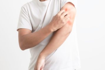 Man,Itching,And,Scratching,His,Arm,From,Allergy,Symptoms,On
