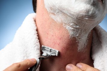 Closeup,Man,Shaving,With,Razor,Burn,Red,Rash,Bumps,Shaving