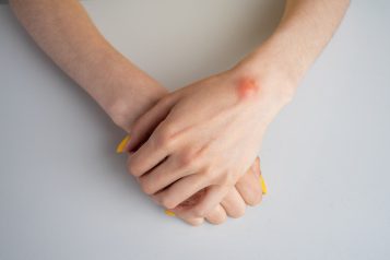 Ganglion,Cyst,On,Woman,Hand,On,White,Background