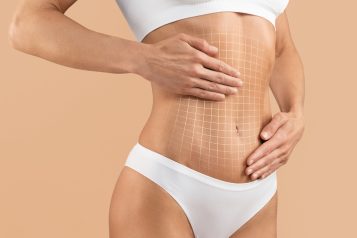 Tackling The Three Common Tummy Tuck Myths