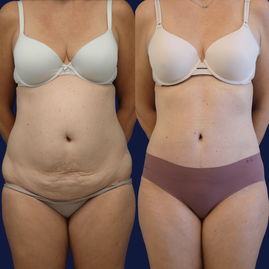 🥇 Liposuction  Maia Plastic Surgery