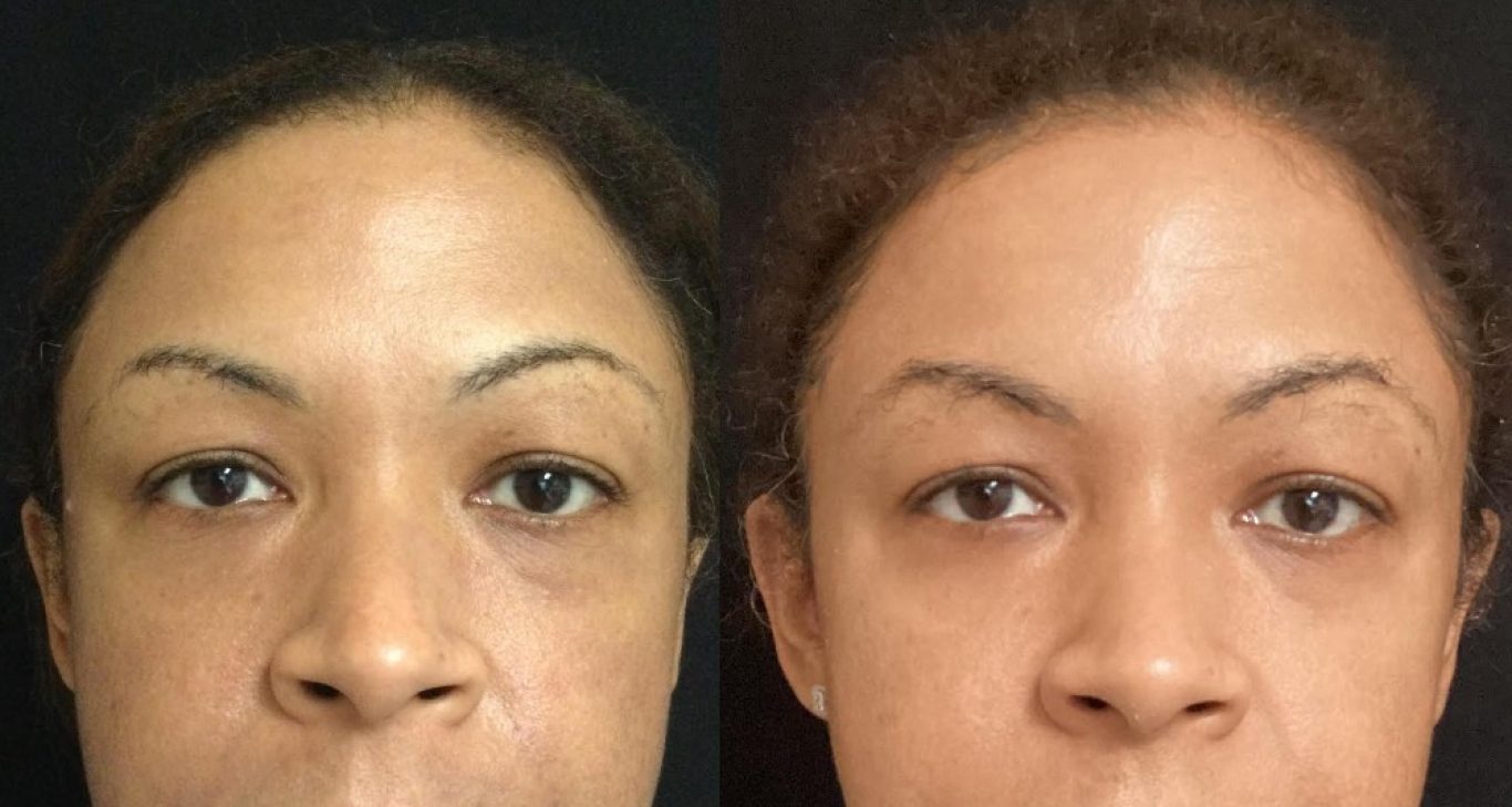 Microneedling Before & After Photos - Dr. Michele Green M.D.
