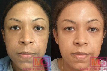 Haute Beauty Dr. Michele S. Green Talks The Benefits Of Microneedling