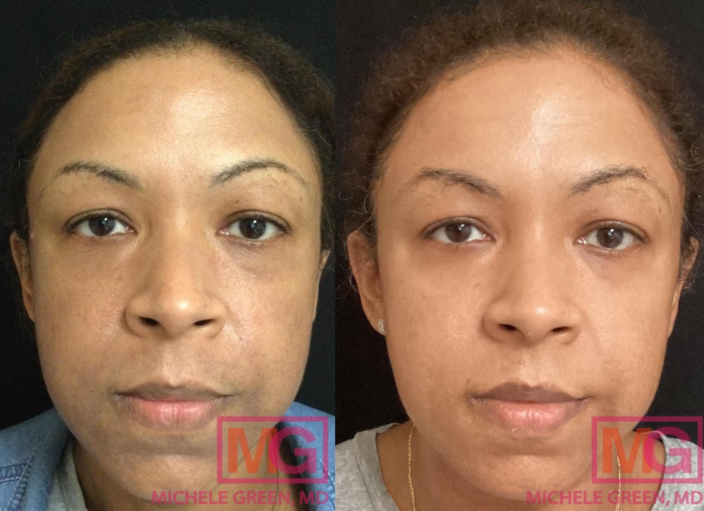 Micro-needling before and after pictures - Boston, MA