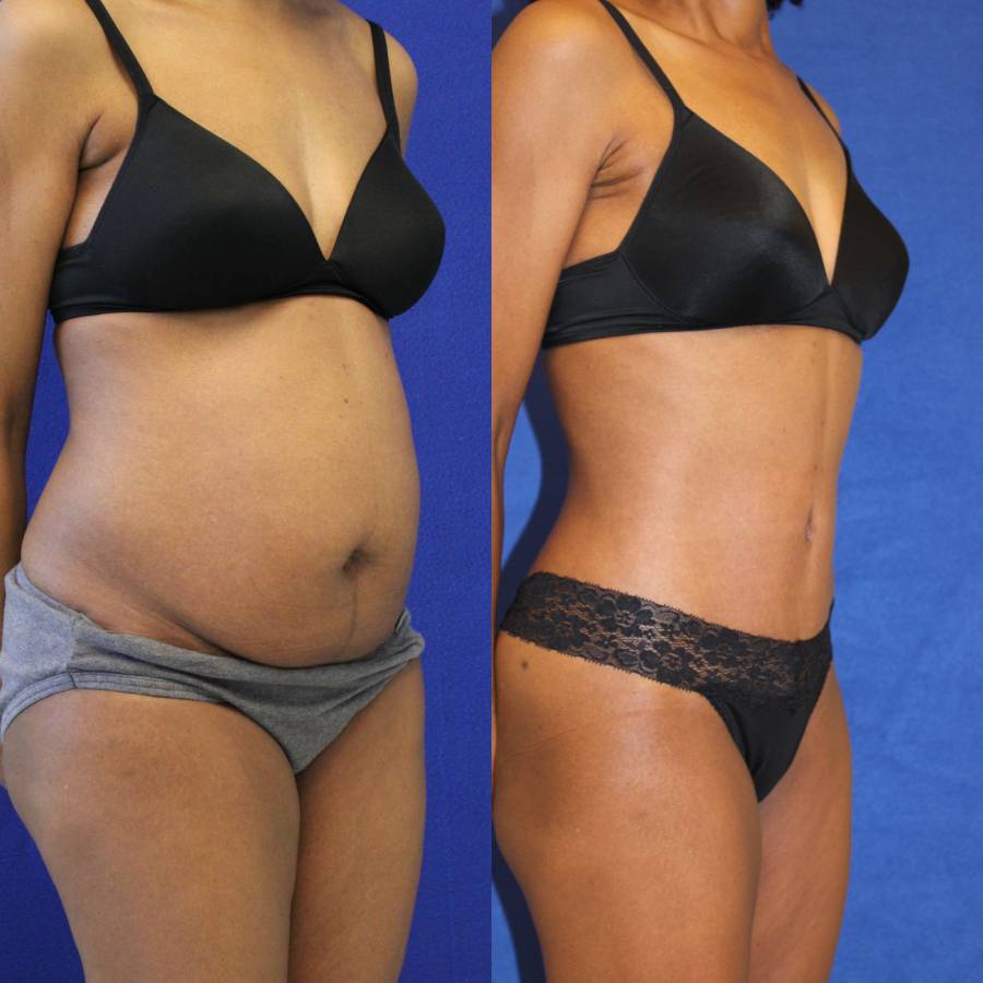 53 year-old patient before and after-abdominoplasty and flanks liposuction1