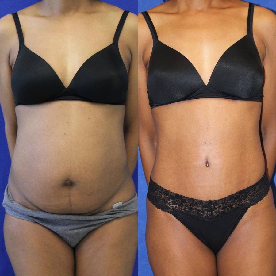 53 year-old patient before and after-abdominoplasty and flanks liposuction2