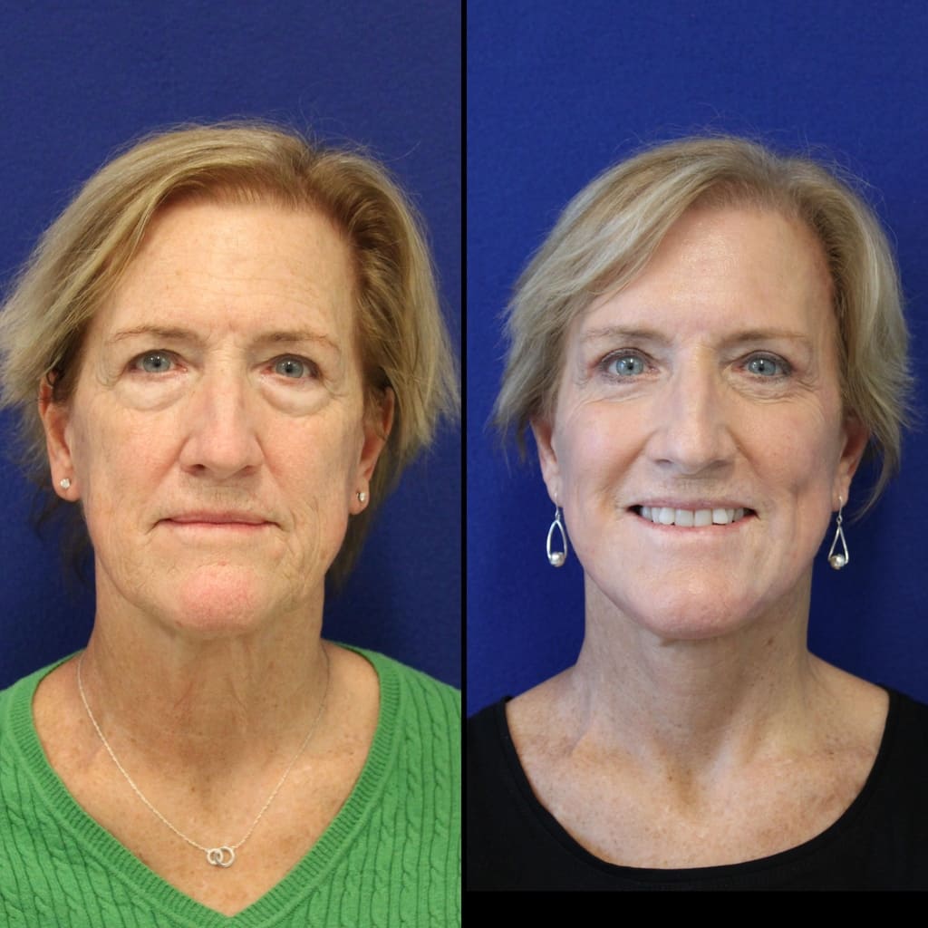 63 year-old patient before and after facelift, neck lift, lower and upper blepharoplasty, brow lift, canthopexy, fat grafting and CO2 laser4