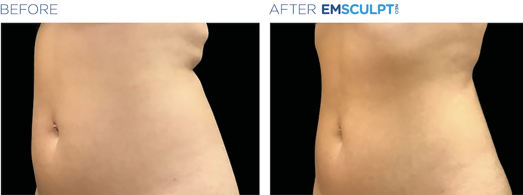 Emsculpt NEO Long Island NY