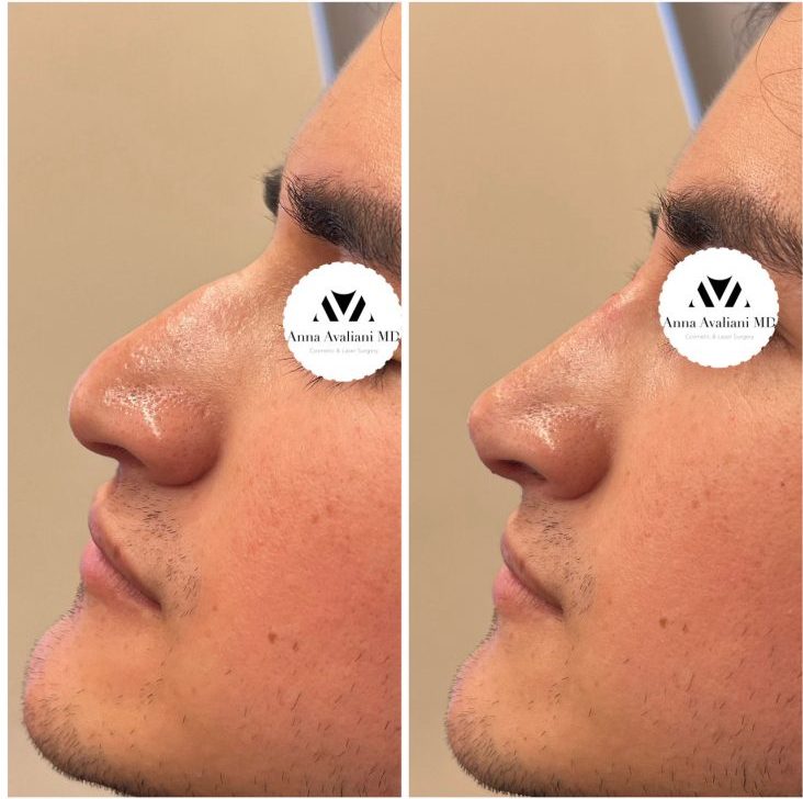 The Five Ways Non-Surgical Rhinoplasty Can Transform Your Look