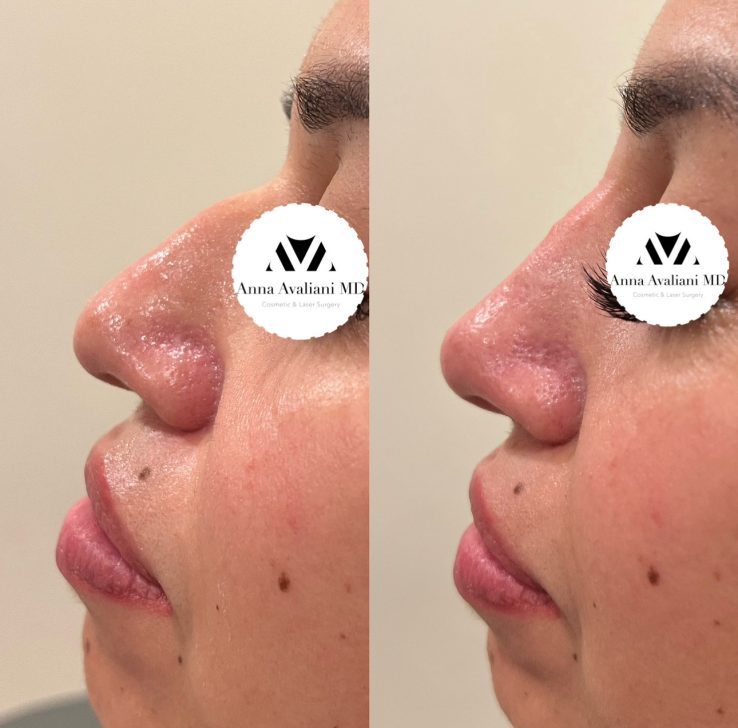 Reviving an Upturned Nose: The History and Techniques of Rhinoplasty -  Atlanta Liposuction Specialty Clinic