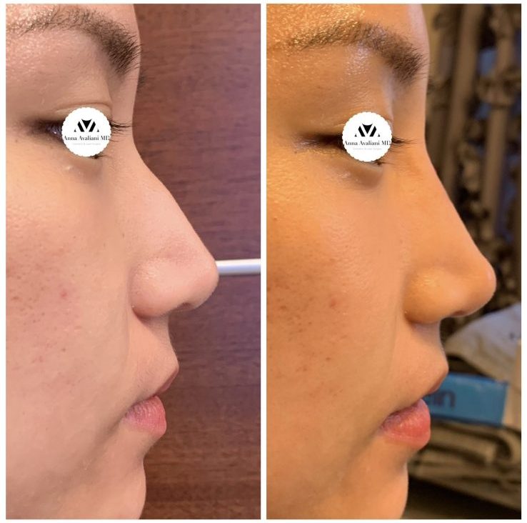 Reviving an Upturned Nose: The History and Techniques of Rhinoplasty -  Atlanta Liposuction Specialty Clinic