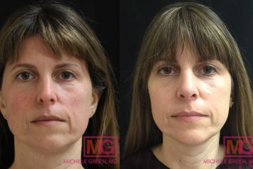 LL-35-44-before-after-thermage-and-injectables-jan-2018-FRONT-2-MGwatermark