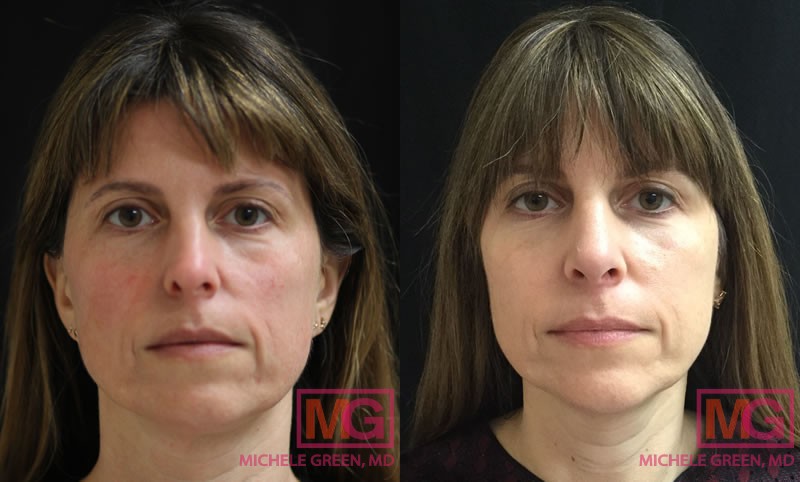 Dr. Michele S. Green Reviews The Best Laser Skin Tightening Options