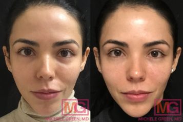 Exploring The Types Of Facial Fillers: A Review By Haute Beauty Expert Dr. Michele Green