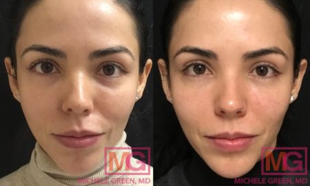 Microneedling Before & After Photos - Dr. Michele Green M.D.