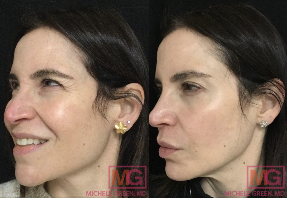Microneedling Before & After Photos - Dr. Michele Green M.D.